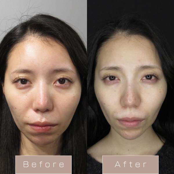 糸リフト（PDO+Lスレット）