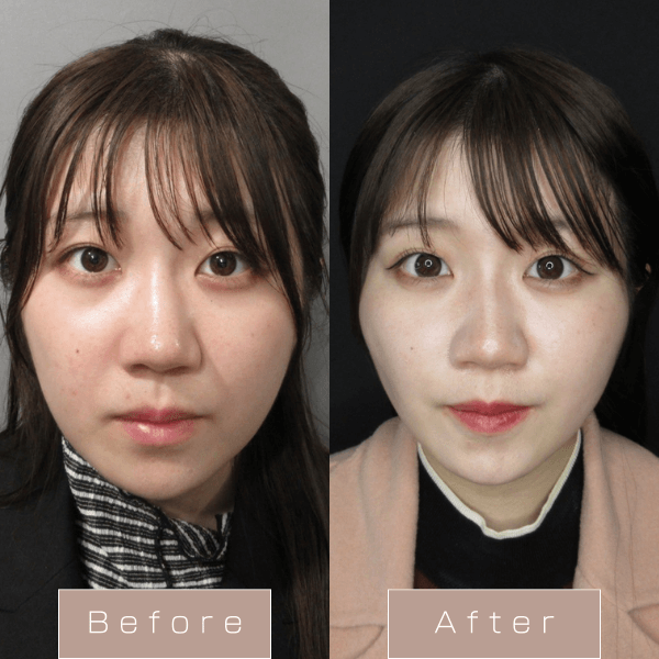 糸リフト（WPCL）８本