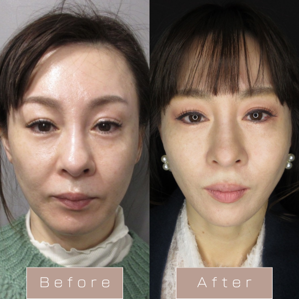 糸リフト（WPCL）８本