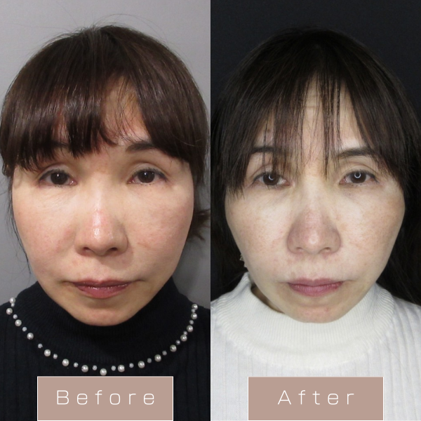 糸リフト（WPCL）８本