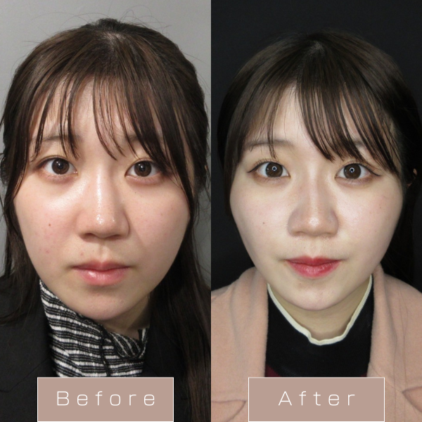 糸リフト（WPCL）８本