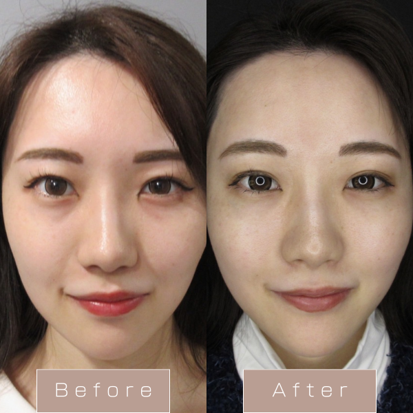 糸リフト（WPCL）８本