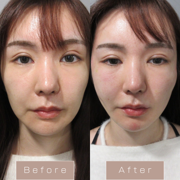 糸リフト（ビタミンスレット）