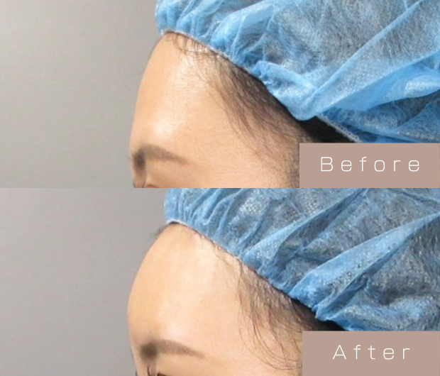 額ヒアルロン酸