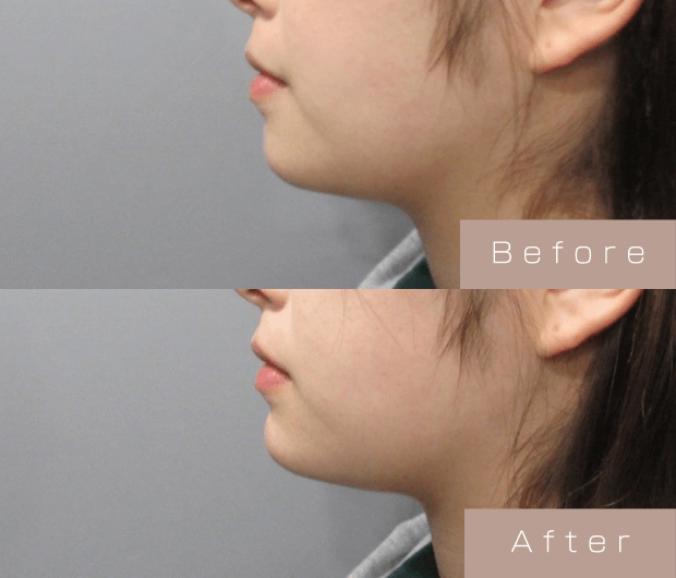 顎ヒアルロン酸