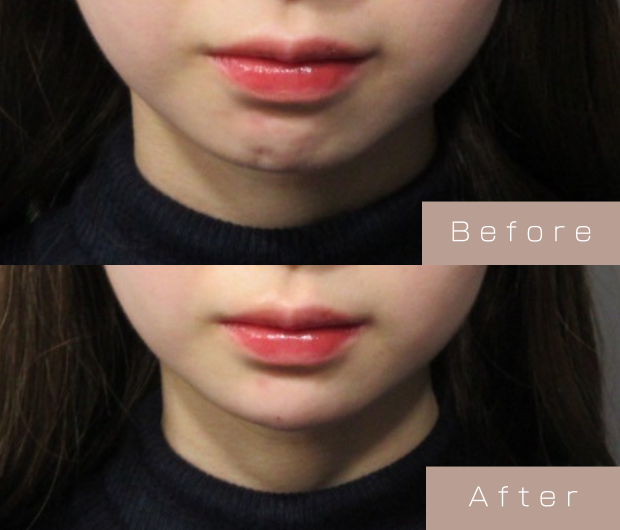 顎ヒアルロン酸