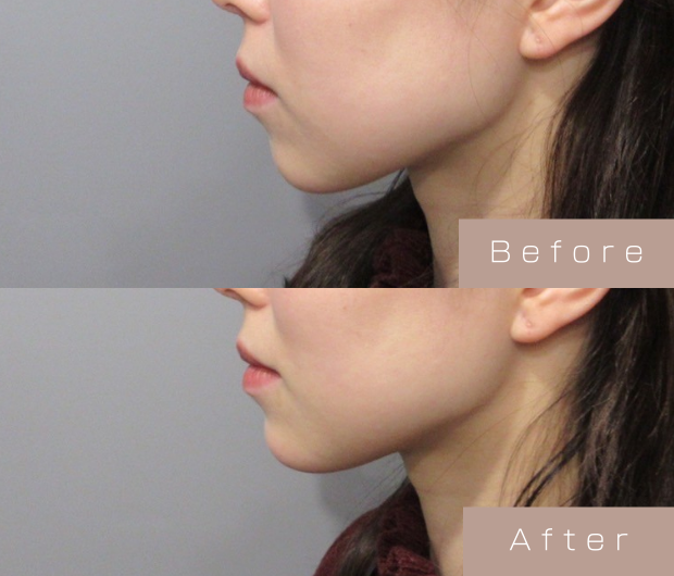 顎ヒアルロン酸