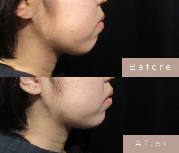 顎ヒアルロン酸