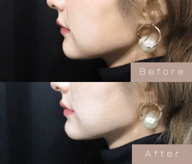 顎ヒアルロン酸