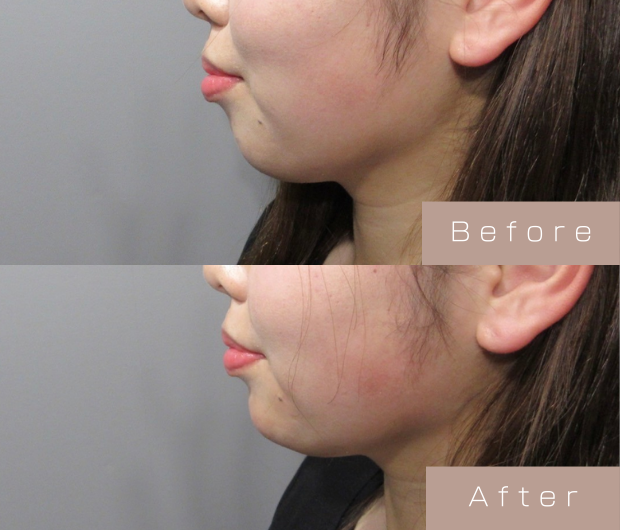 顎ヒアルロン酸