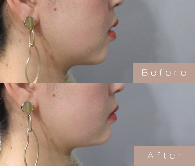 顎ヒアルロン酸