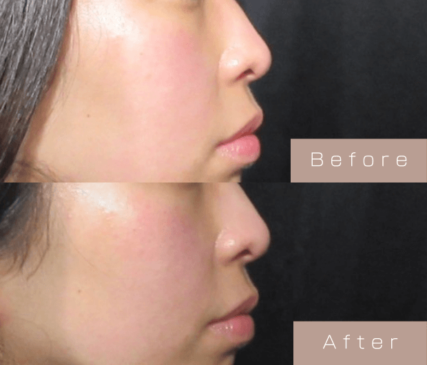 鼻ヒアルロン酸