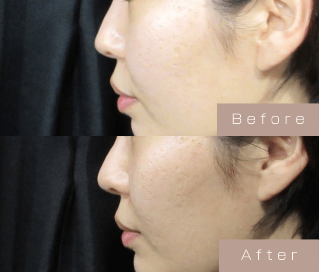 鼻ヒアルロン酸