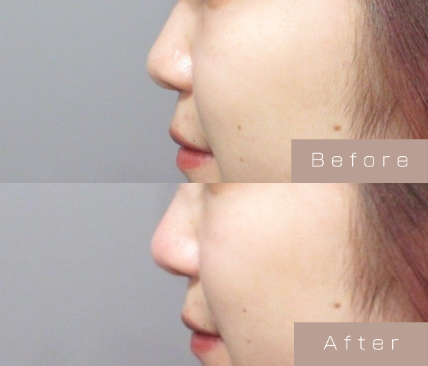 鼻ヒアルロン酸