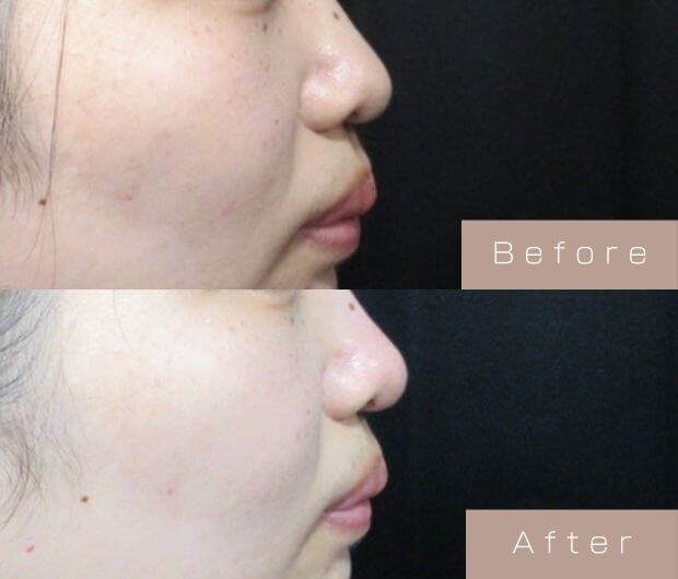 鼻ヒアルロン酸