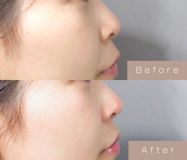 鼻ヒアルロン酸
