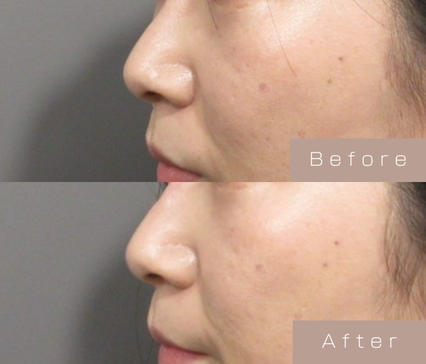 鼻ヒアルロン酸