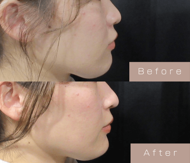 鼻ヒアルロン酸