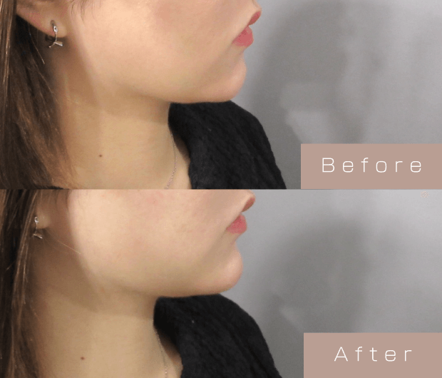 顎ヒアルロン酸