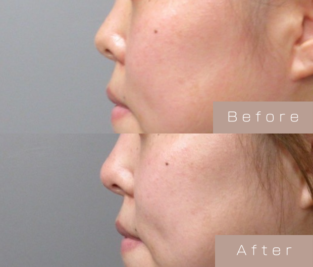 鼻ヒアルロン酸