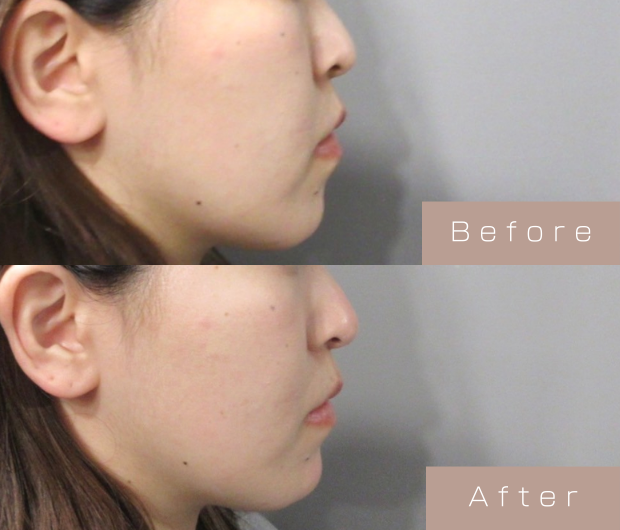 鼻ヒアルロン酸
