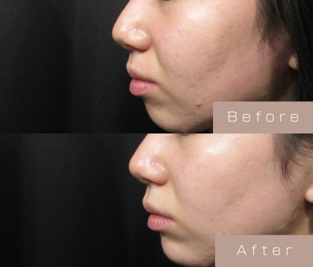 鼻ヒアルロン酸