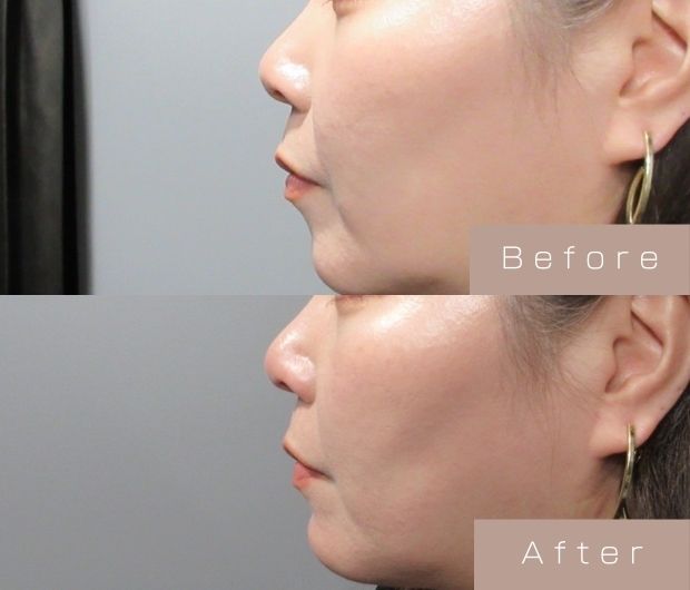 鼻ヒアルロン酸