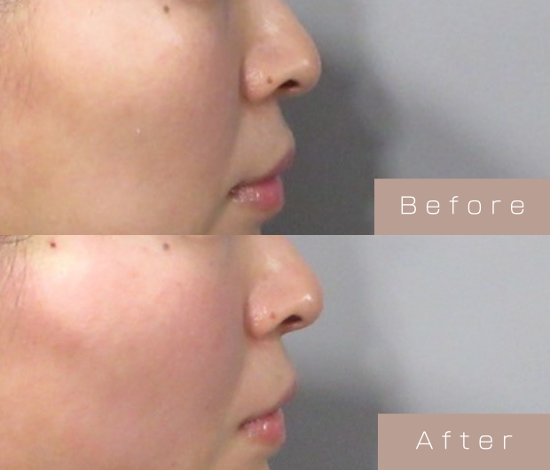 鼻ヒアルロン酸