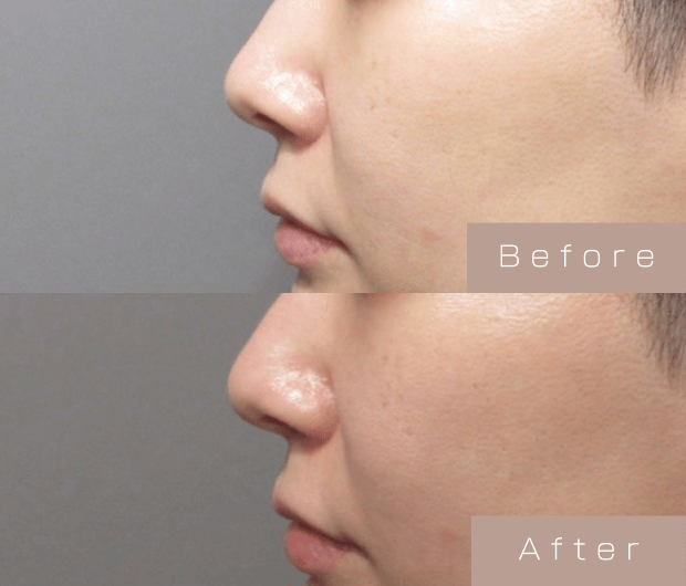 鼻ヒアルロン酸