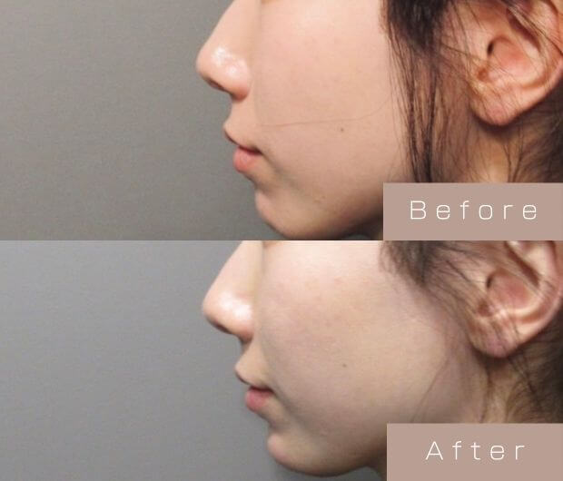 鼻ヒアルロン酸