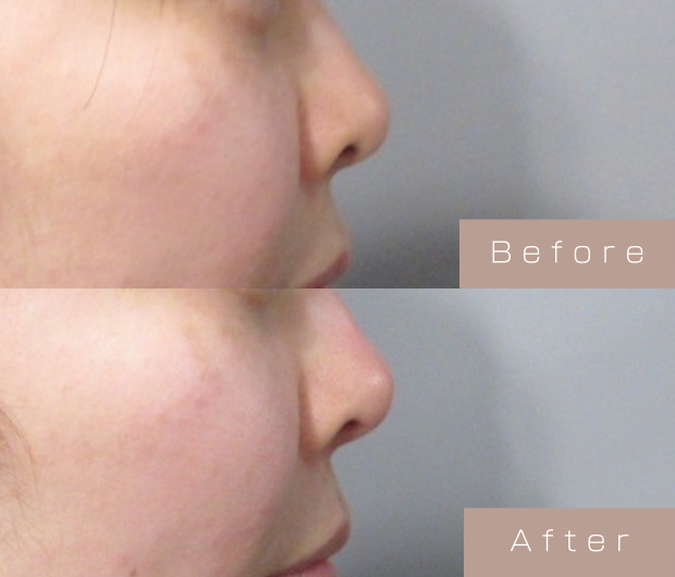 鼻ヒアルロン酸