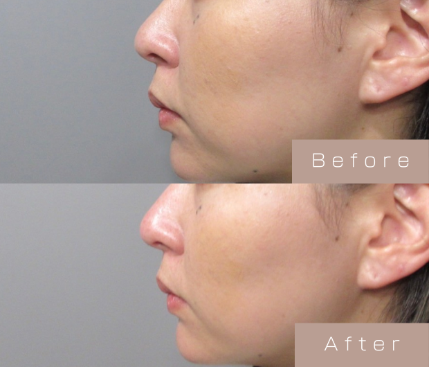 鼻ヒアルロン酸