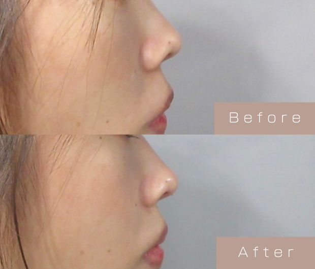 鼻ヒアルロン酸