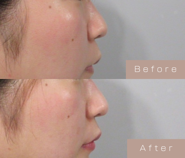 鼻ヒアルロン酸