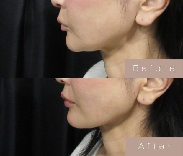 顎ヒアルロン酸