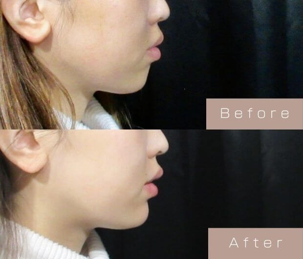 顎ヒアルロン酸