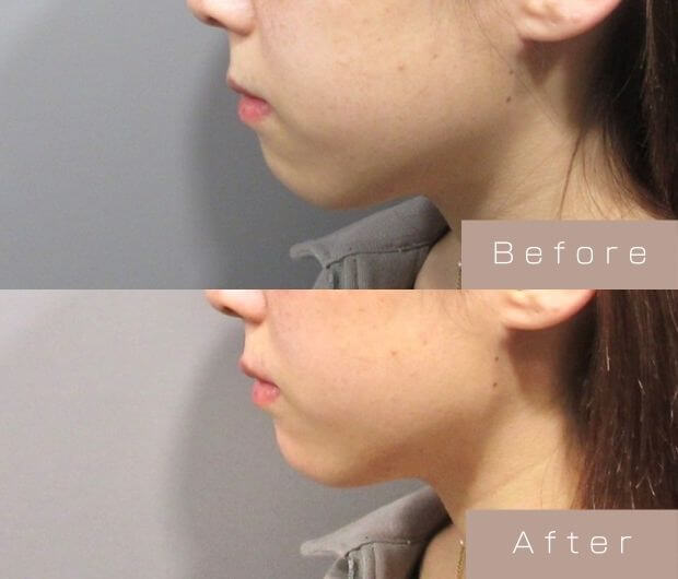 顎ヒアルロン酸