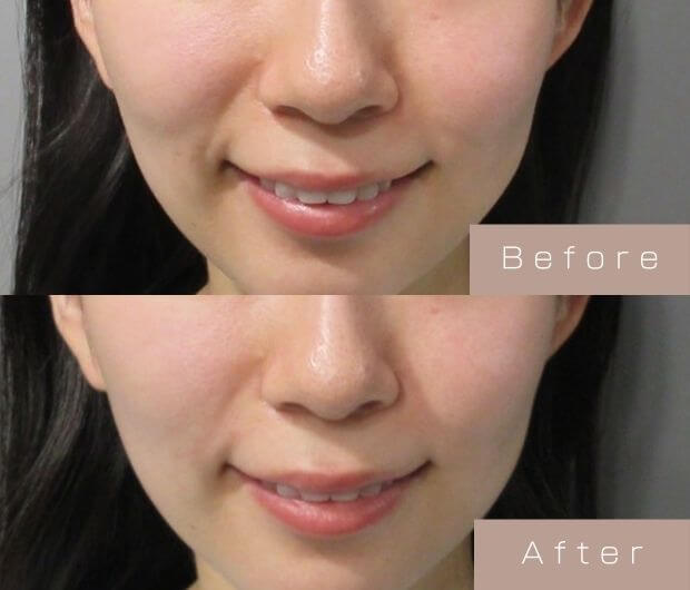 ほうれい線ヒアルロン酸