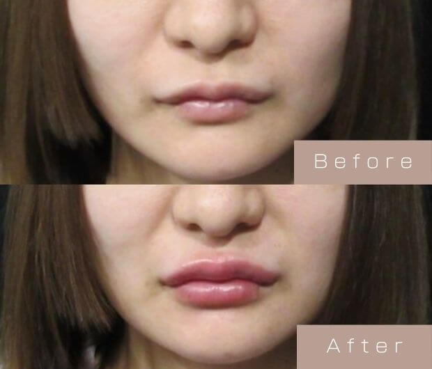 スマイルリップ