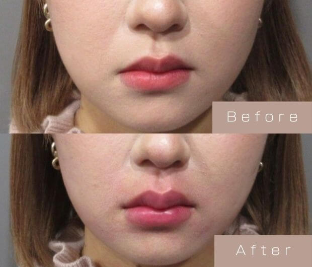 スマイルリップ