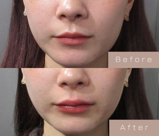 スマイルリップ