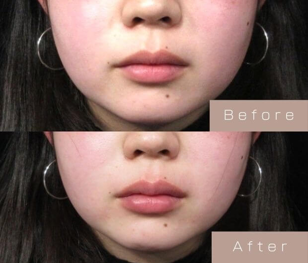 スマイルリップ