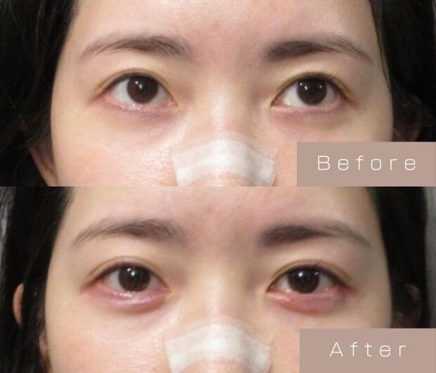 涙袋ヒアルロン酸