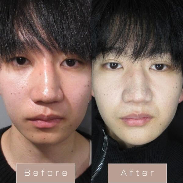 糸リフト（PDO）