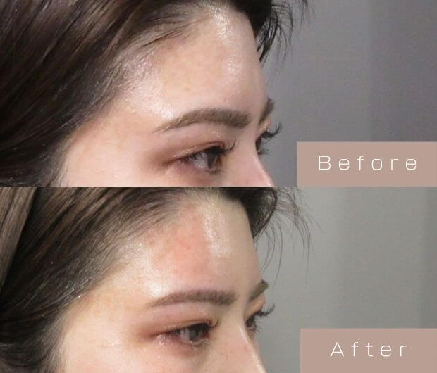 額ヒアルロン酸