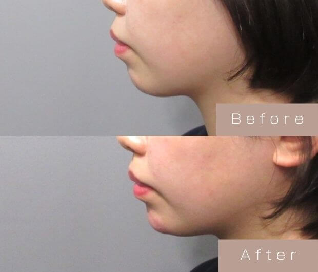 顎ヒアルロン酸