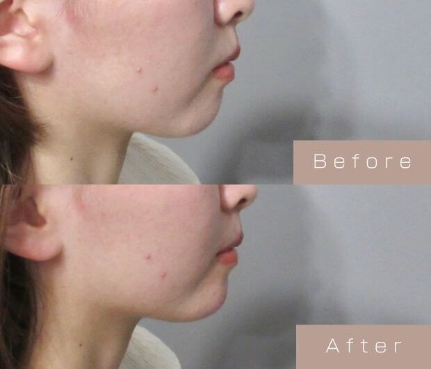 顎ヒアルロン酸