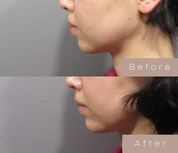 顎ヒアルロン酸