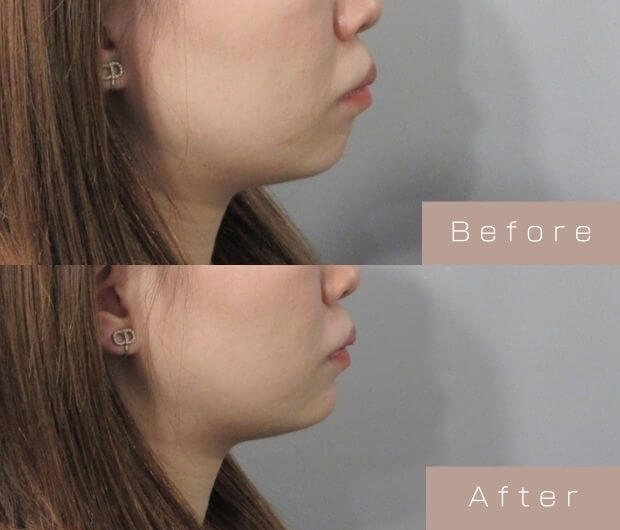 顎ヒアルロン酸