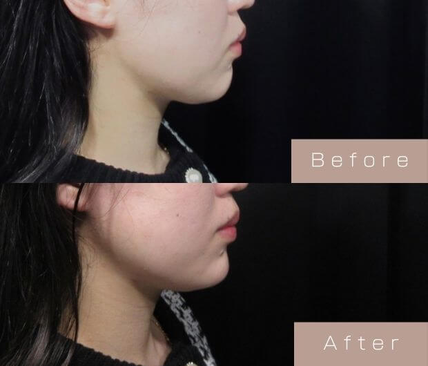 顎ヒアルロン酸